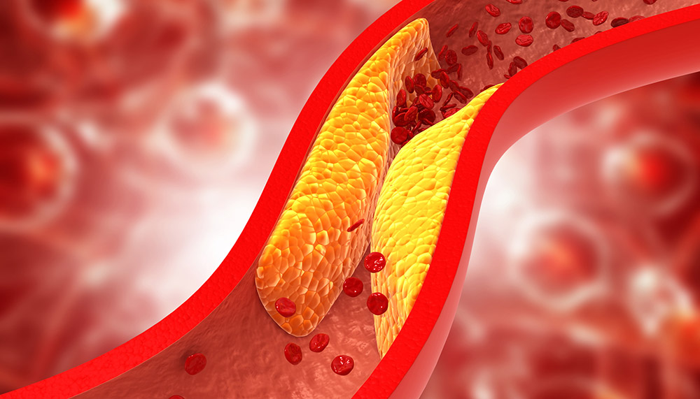 Hohes Cholesterin – Was tun?